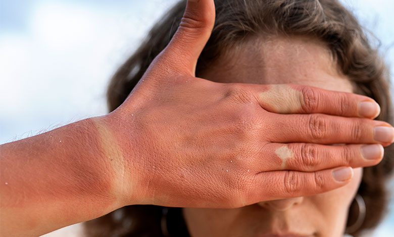 درمان آفتاب سوختگی