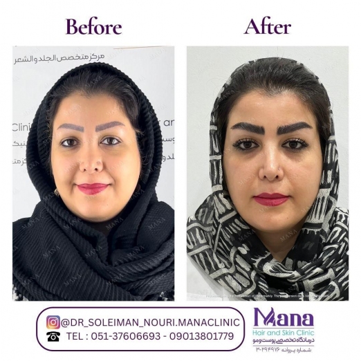 کاشت ابرو در مشهد