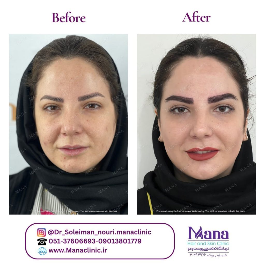 کاشت ابرو در مشهد